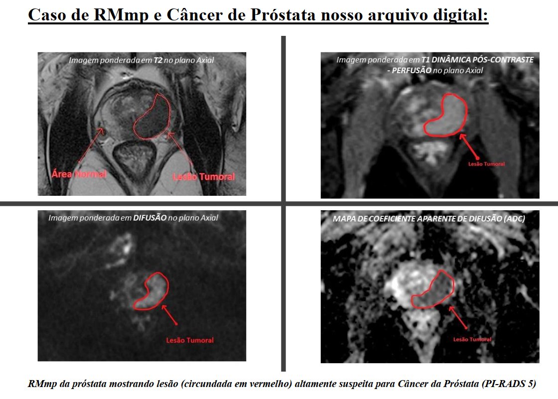 Diffusionsgewichtete MRT der Prostata | prostatita.adonisfarm.ro