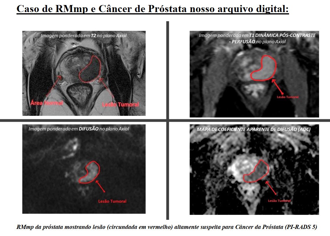 Cncer de Prstata