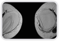 Ruptura Intracapsular Bilateral do Implante De Silicone + Neoplasia na Mama Esquerda