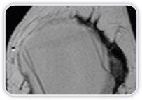 Ruptura Intracapsular Bilateral do Implante De Silicone + Neoplasia na Mama Esquerda