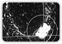 Ruptura Intracapsular Bilateral do Implante De Silicone + Neoplasia na Mama Esquerda