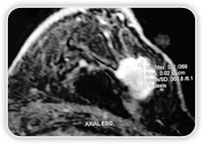 Ruptura Intracapsular Bilateral do Implante De Silicone + Neoplasia na Mama Esquerda