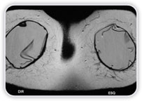 Implantes com Formato Redondo Imagens Lineares com Orientao no Radial Reduo de Dobras Radiais Espessamento de Cpsula Fibrosa