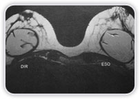 Implantes com Formato Redondo Imagens Lineares com Orientao no Radial Reduo de Dobras Radiais Espessamento de Cpsula Fibrosa