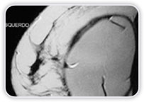 Implantes com Formato Redondo Imagens Lineares com Orientao no Radial Reduo de Dobras Radiais Espessamento de Cpsula Fibrosa