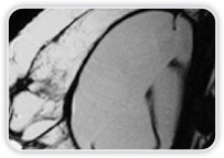 Implantes com Formato Redondo Imagens Lineares com Orientação não Radial Redução de Dobras Radiais Espessamento de Cápsula Fibrosa