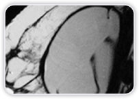 Implantes com Formato Redondo Imagens Lineares com Orientao no Radial Reduo de Dobras Radiais Espessamento de Cpsula Fibrosa