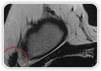 Implantes De Silicone - Carcinoma Ductal Invasor No Quadrante Superior Lateral Da Mama Dir.