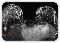 Implantes De Silicone - Carcinoma Ductal Invasor No Quadrante Superior Lateral Da Mama Dir.