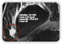 Implantes De Silicone - Carcinoma Ductal Invasor No Quadrante Superior Lateral Da Mama Dir.