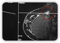 Implantes De Silicone - Carcinoma Ductal Invasor No Quadrante Superior Lateral Da Mama Dir.