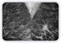 Carcinoma Ductal Invasor + Focos De Carcinoma Ductal In Situ Na Mama Esq.