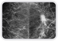 Carcinoma Ductal Invasor + Focos De Carcinoma Ductal In Situ Na Mama Esq.