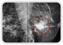 Carcinoma Ductal Invasor em Interquadrantes Mediais Mama Esquerda