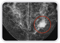 Carcinoma Ductal Invasor em Interquadrantes Mediais Mama Esquerda