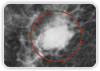 Carcinoma Ductal Invasor em Interquadrantes Mediais Mama Esquerda