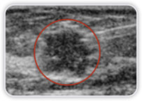 Carcinoma Ductal Invasor em Interquadrantes Mediais Mama Esquerda