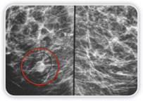 Carcinoma Ductal Invasor na Mama Dir - Boa Correlao: MMG - US - RM<