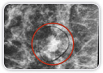 Carcinoma Ductal Invasor na Mama Dir - Boa Correlao: MMG - US - RM<