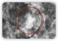 Carcinoma Ductal Invasor na Mama Dir - Boa Correlao: MMG - US - RM<