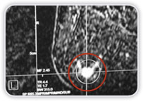 Carcinoma Ductal Invasor na Mama Dir - Boa Correlao: MMG - US - RM<