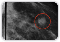 Carcinoma Ductal Invasor em Quadrante Superior Lateral na Mama Esquerda