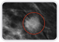 Carcinoma Ductal Invasor em Quadrante Superior Lateral na Mama Esquerda