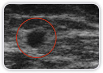 Carcinoma Ductal Invasor em Quadrante Superior Lateral na Mama Esquerda