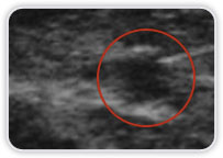 Carcinoma Ductal Invasor em Quadrante Superior Lateral na Mama Esquerda