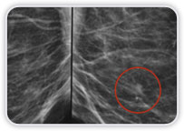 Carcinoma Ductal Invasor na Mama Esquerda