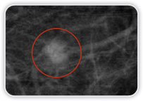 Carcinoma Ductal Invasor na Mama Esquerda