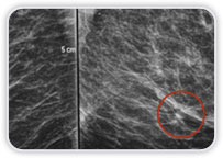 Carcinoma Ductal Invasor na Mama Esq.