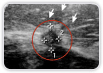 Carcinoma Ductal Invasor na Mama Esq.