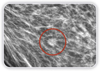 Carcinoma Ductal Invasor no Quadrante Inferior Medial da Mama Esq.