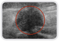 Carcinoma Ductal Invasor no Quadrante Inferior Medial da Mama Esq.