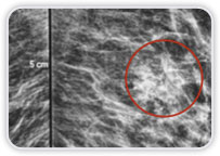 Carcinoma Ductal Invasor no Quadrante Inferior Medial da Mama Esq.