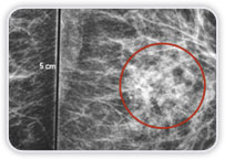 Carcinoma Ductal Invasor no Quadrante Inferior Medial da Mama Esq.