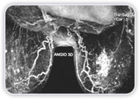 Carcinoma Ductal Invasor no Quadrante Inferior Medial da Mama Esq.